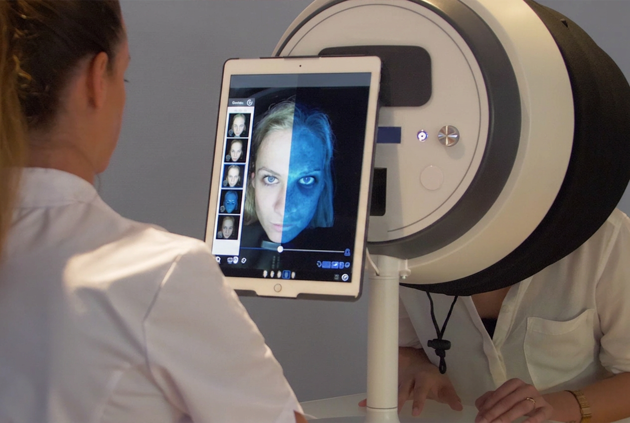 Voorbeeld van roodheid en zichtbare vaatjes bij couperose en rosacea