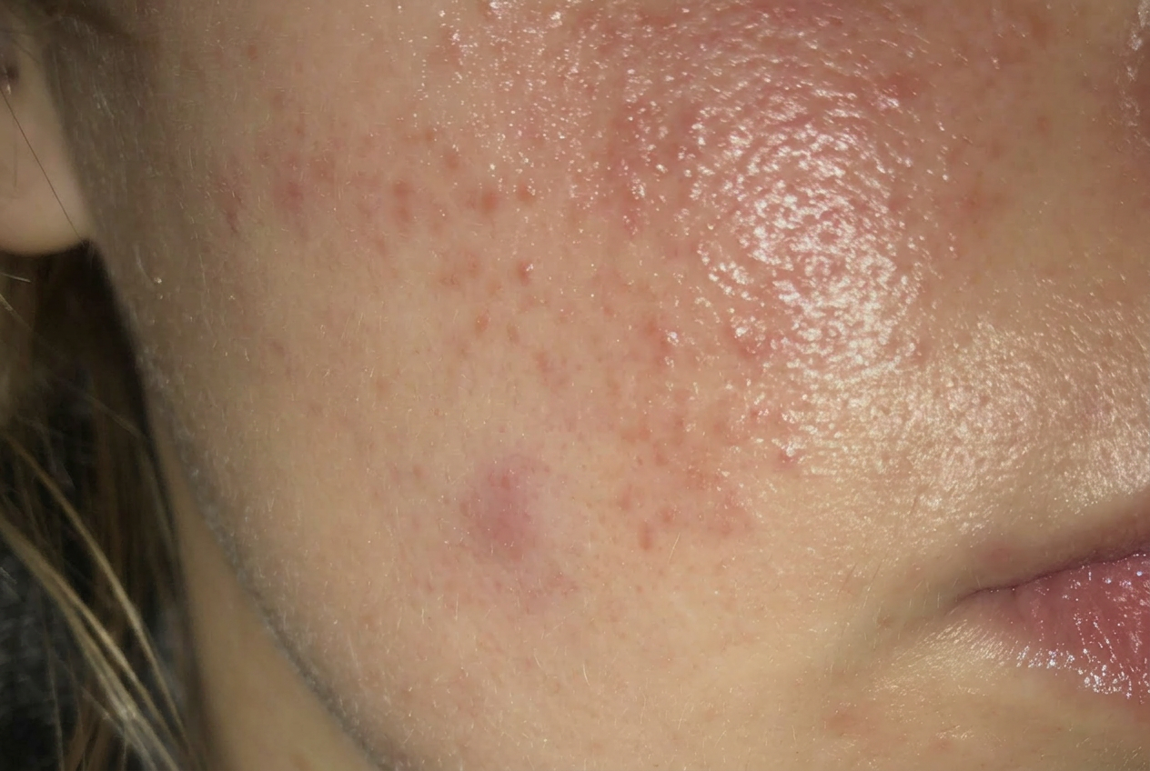 Rosaceahuid met bultjes die op acne lijken